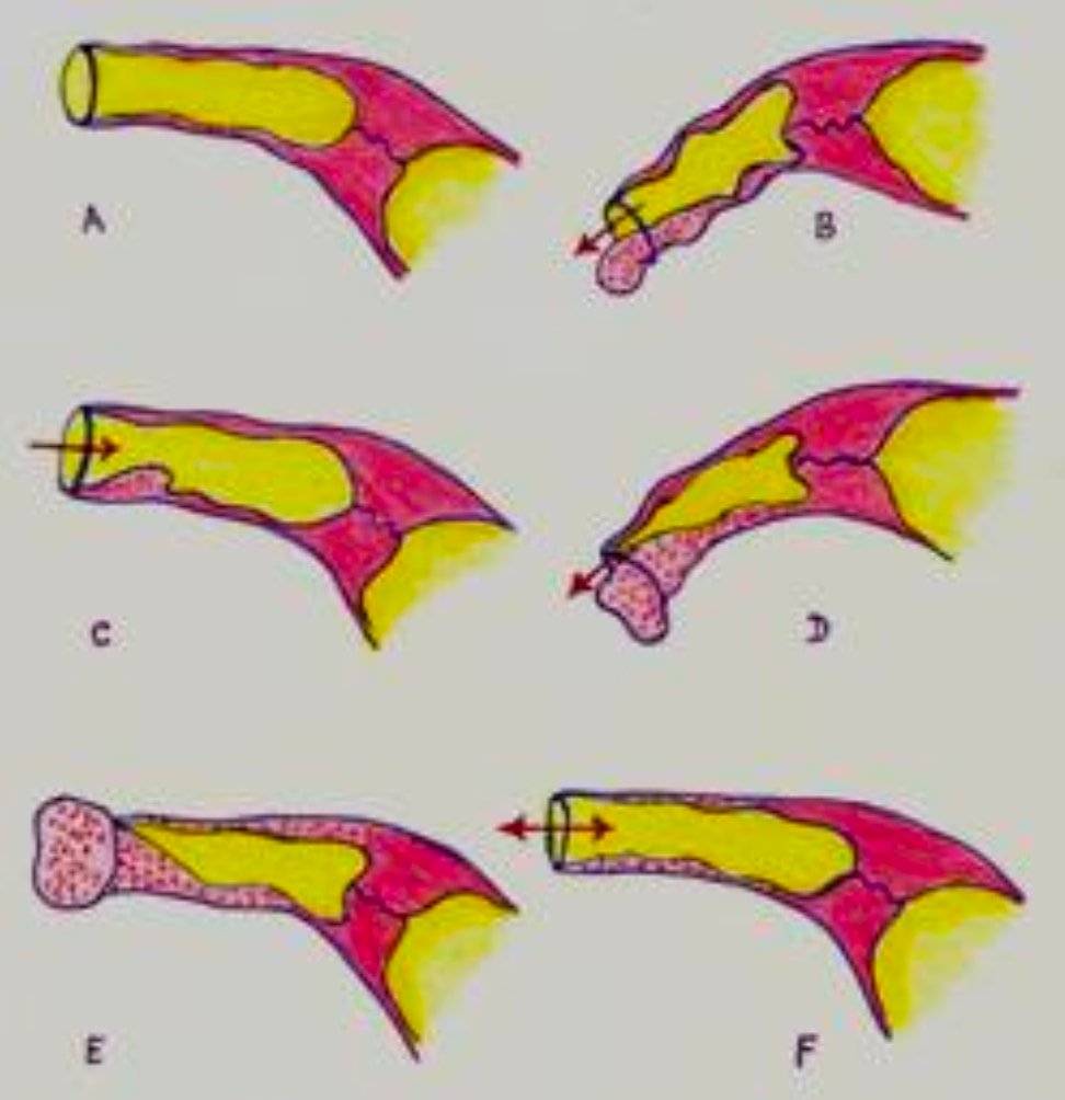 Cervico Vaginal Prolapse