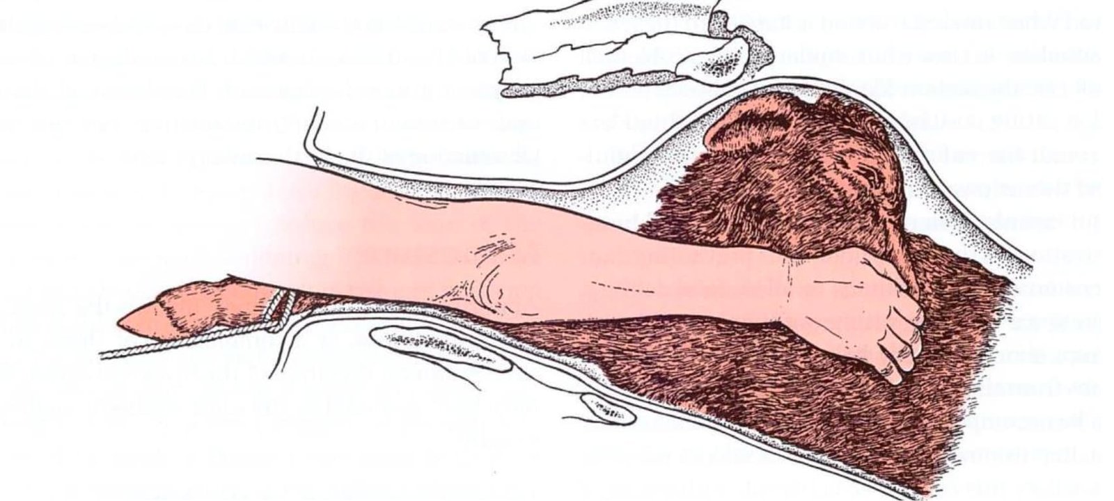 Correction of Lateral Deviation of Head
