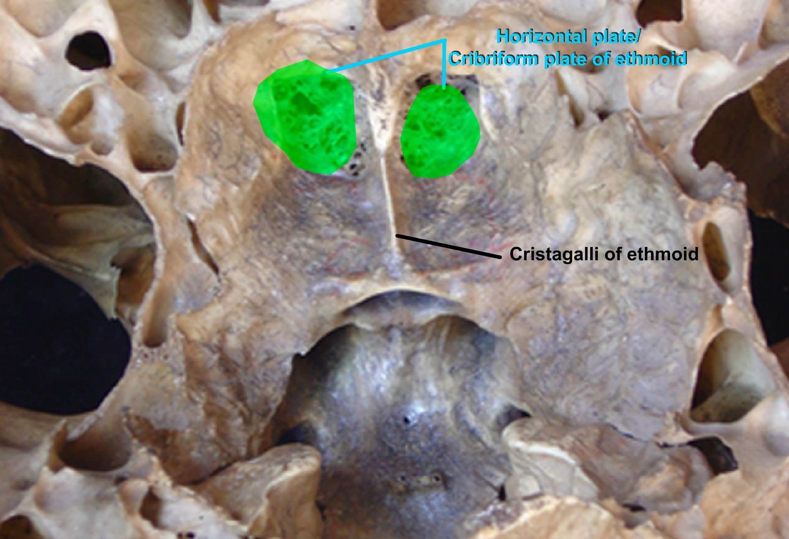 Ethmoid Bone (Horizontal plate or Cribriform plate of ethmoid and Cristagalli of ethmoid)