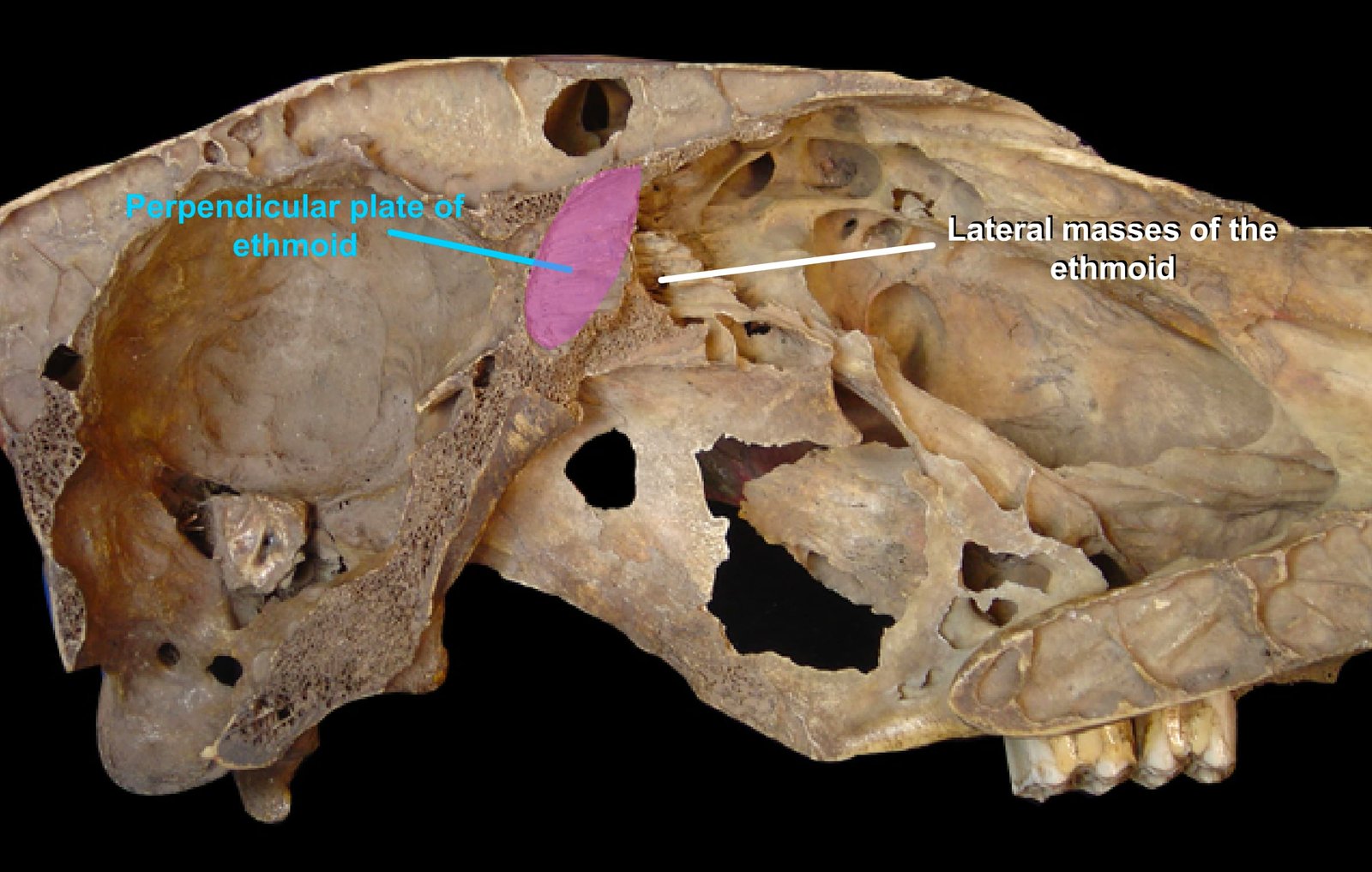 Ethmoid Bone (Perpendicular plate of ethmoid and Lateral masses of the ethmoid)