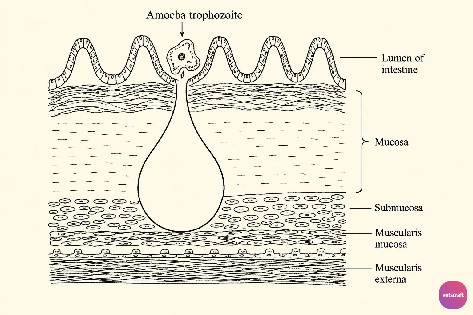 Flask-Shaped Ulcer in Intestinal Amoebiasis