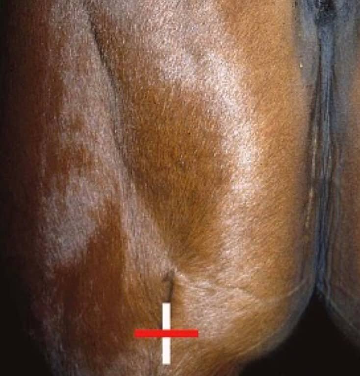 Focal semitendinosus myotomy in a horse