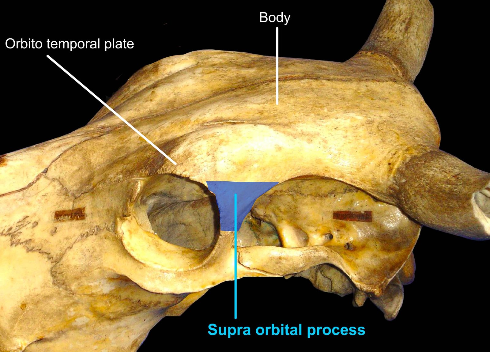 Frontal Bone (Body, Orbito temporal plate and Supraorbital process)