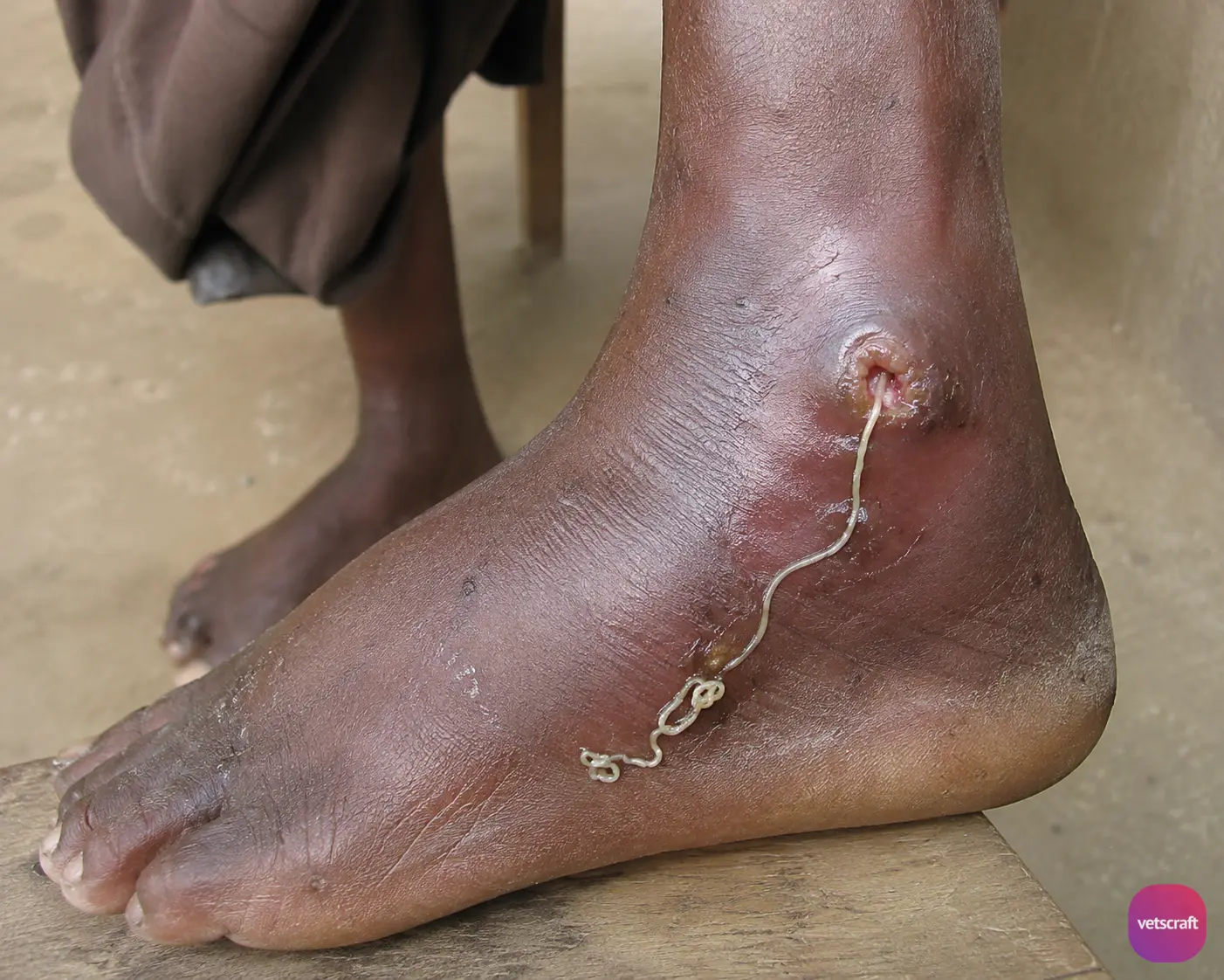 Guinea Worm (Dracunculus medinensis) Infection