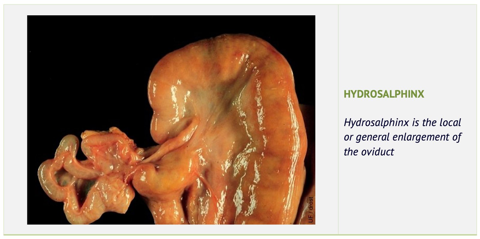 Hydrosalpinx