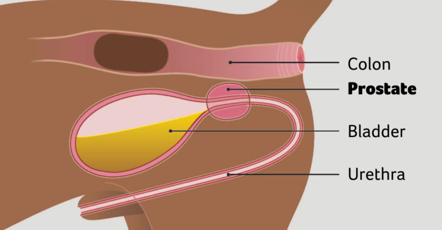 Prostatitis Cat Pathology of the Prostate Gland | Prostatitis, Hyperplasia & Tumors
