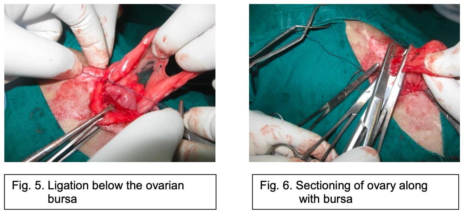 Ligation below the ovarian bursa and Sectioning of ovary along with bursa