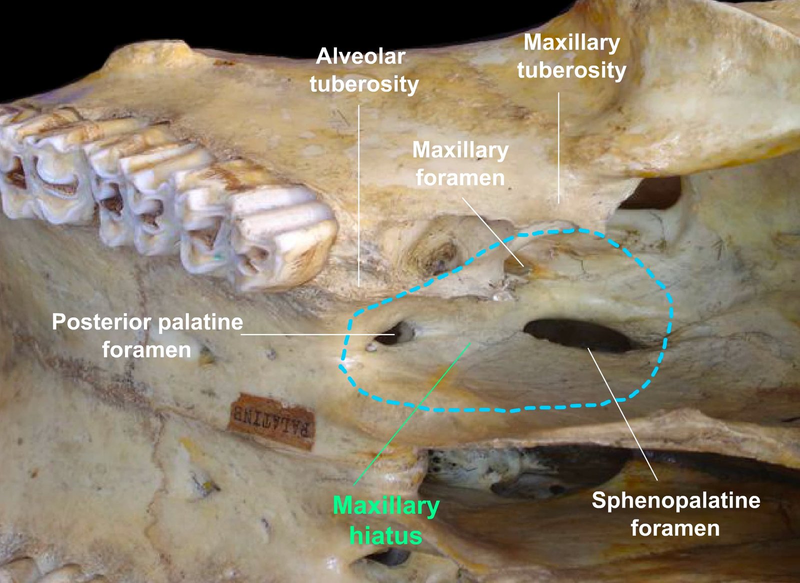 Medial Surface of the Maxilla Bone Showing the Maxillary Hiatus and Associated Foramina