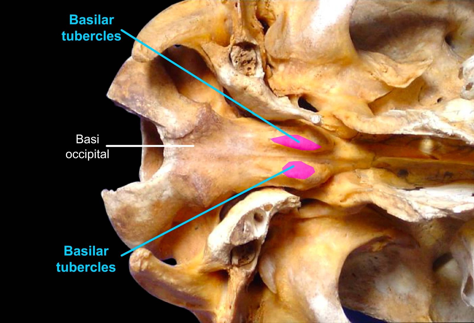 Occipital Bone (Basilar Tubercles and Basi Occipital)