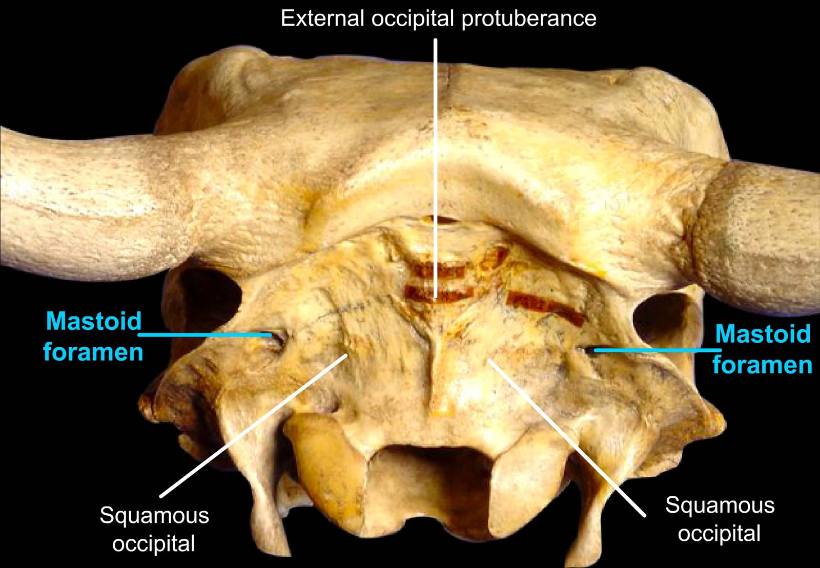 Occipital Bone (External Occipital Protuberance, Mastoid Foramen and Squamous Occipital)