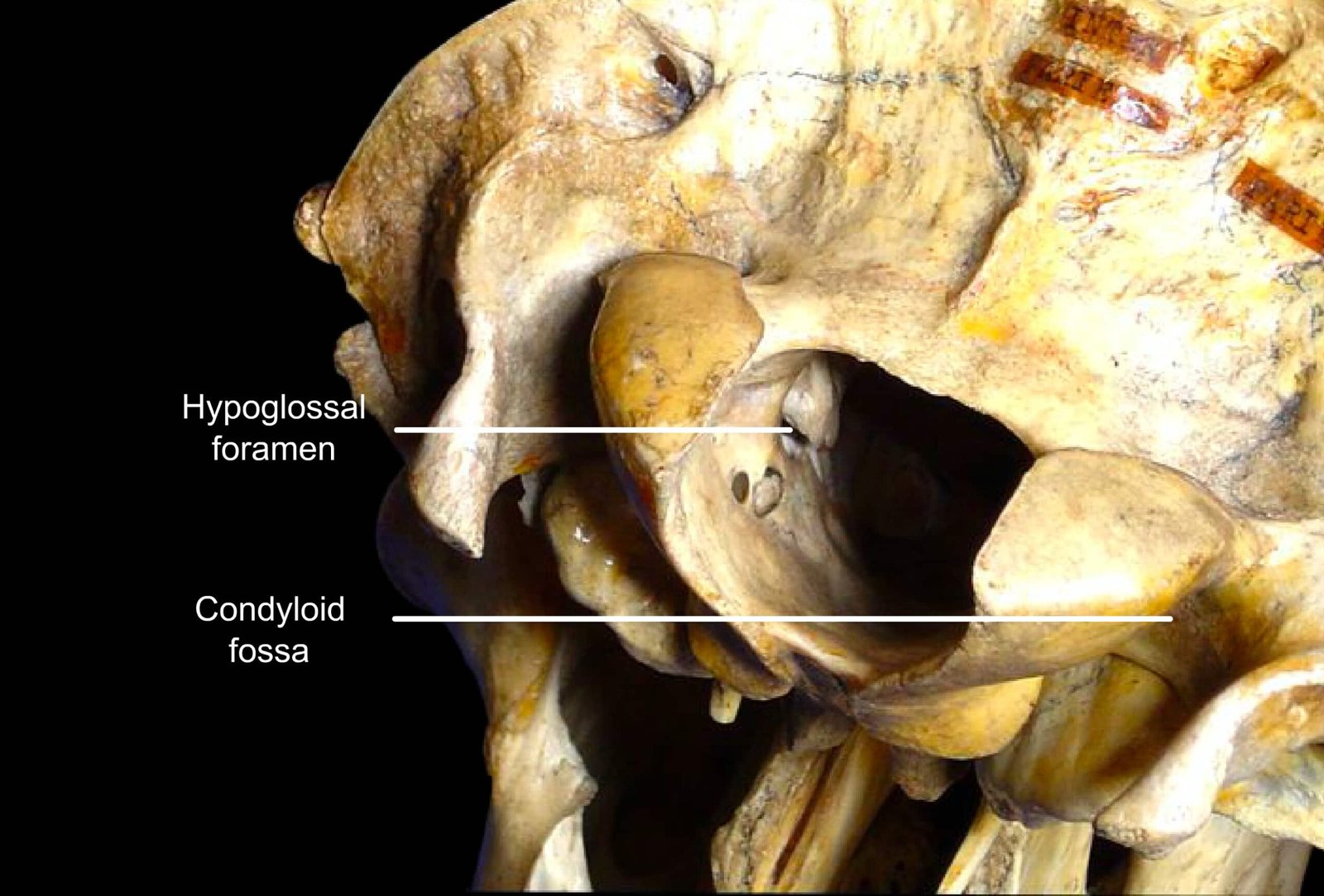 Occipital Bone (Hypoglossal Foramen and Condyloid Fossa)