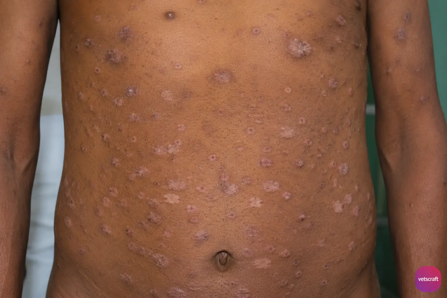 PKDL (Post Kala-azar Dermal Leishmaniasis)