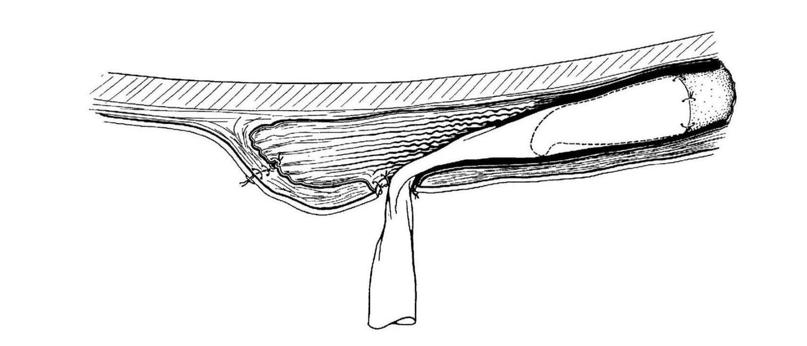 Penrose drain placed to facilitate Urine Divergence