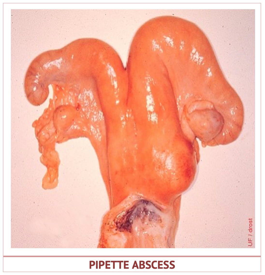 Pipette Abscess in Uterus