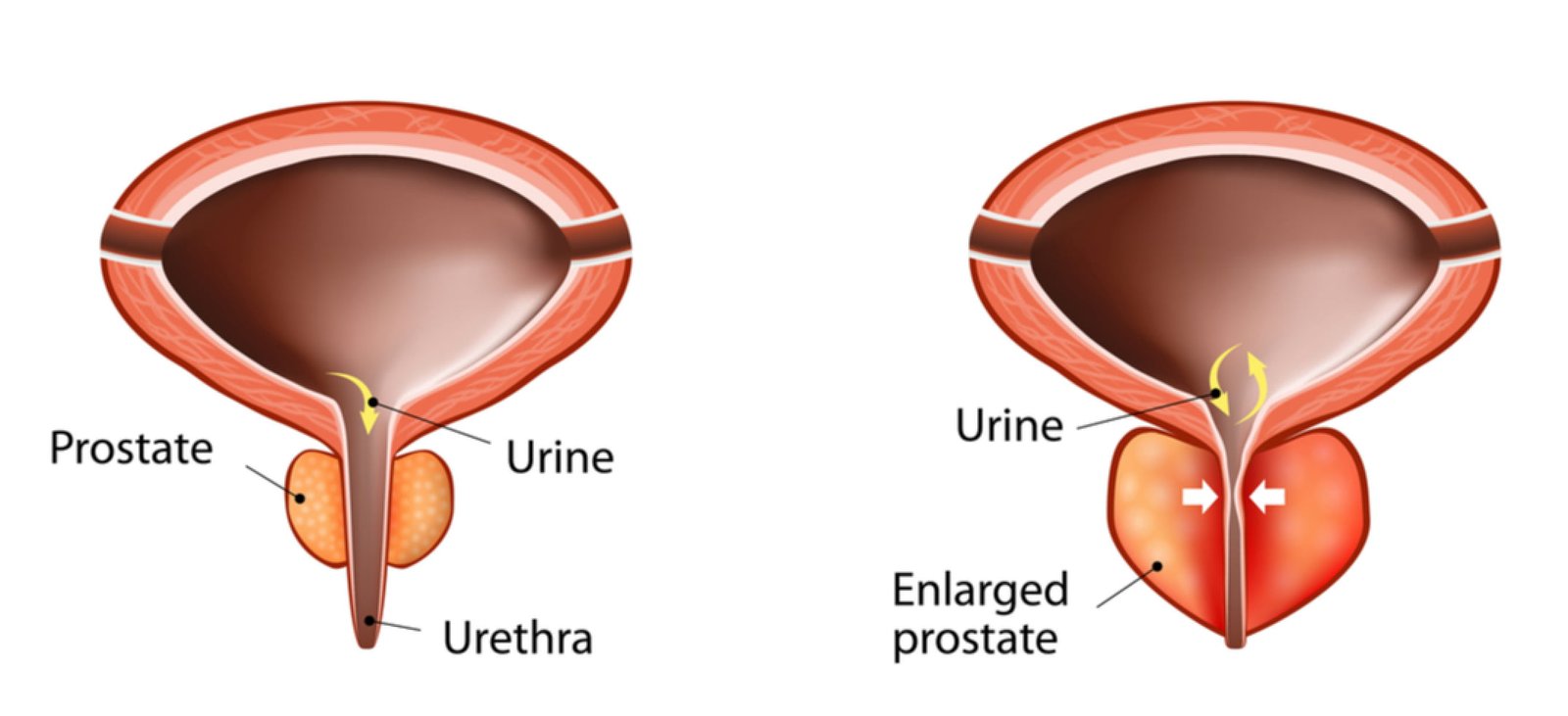 Prostatic Hyperplasia Diagram