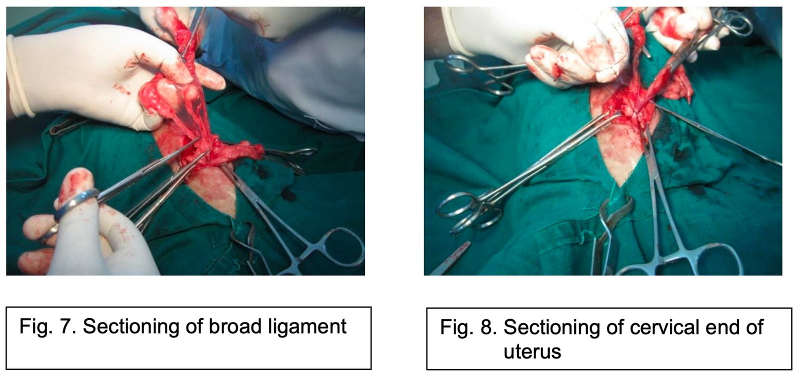 Sectioning of broad ligament and Sectioning of cervical end of uterus