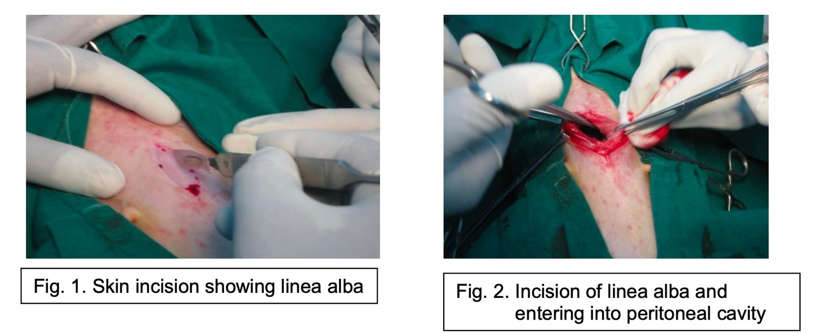 Skin incision showing linea alba, Incision of linea alba and entering into peritoneal cavity