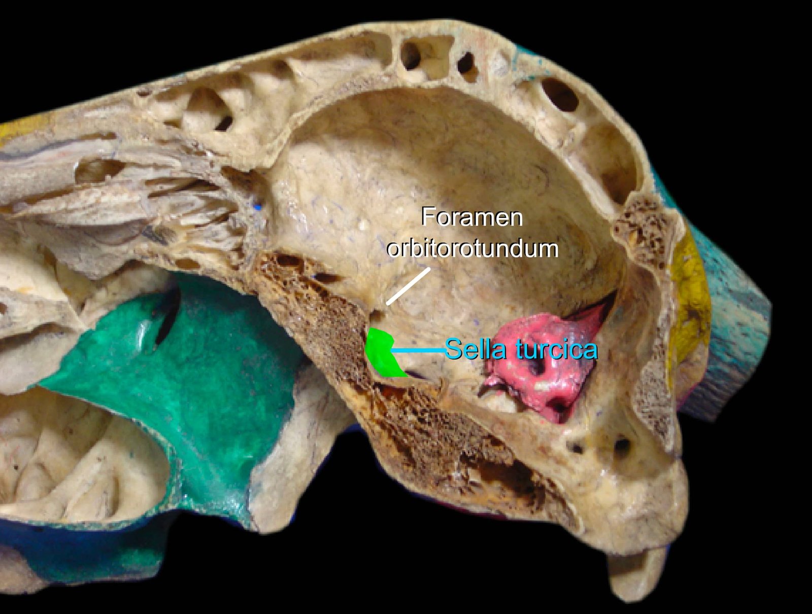 Sphenoid Bone (Foramen orbitorotundum and Sella turcica)