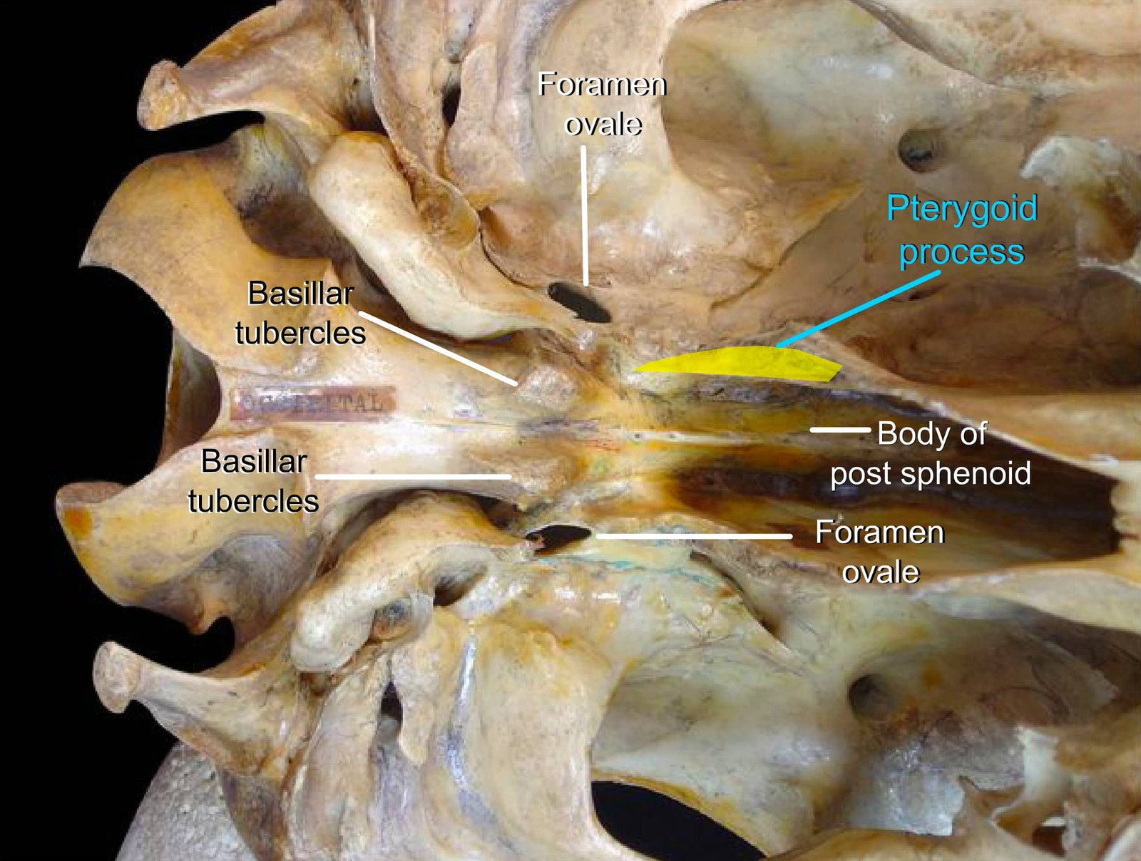 Sphenoid Bone (Foramen ovale, Basilar tubercles, Pterygoid process, Body of post sphenoid)