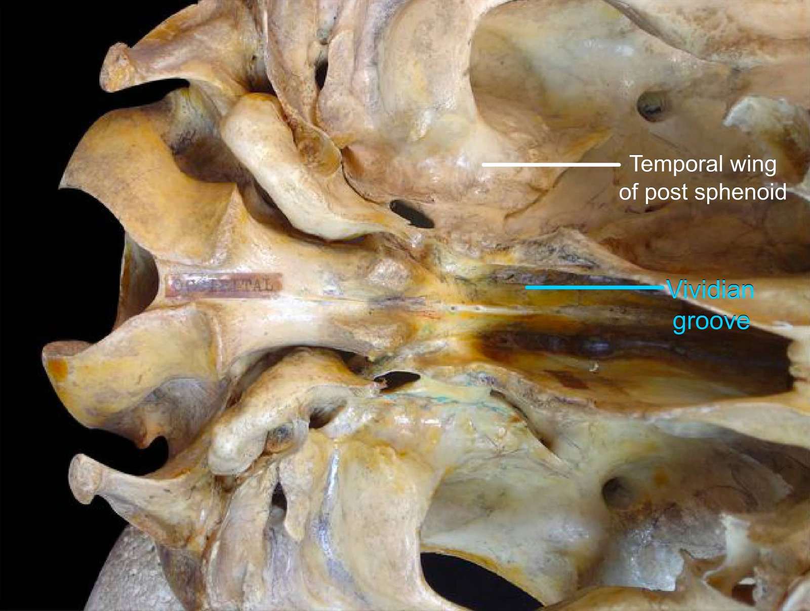 Sphenoid Bone (Temporal wing of post sphenoid and Vividian groove)