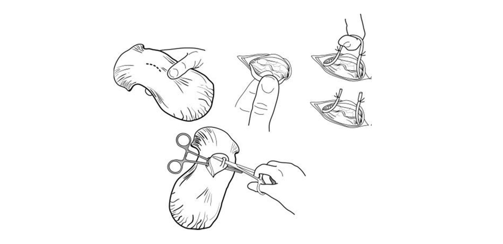Surgical Procedure Diagram of Vasectomy in Bulls