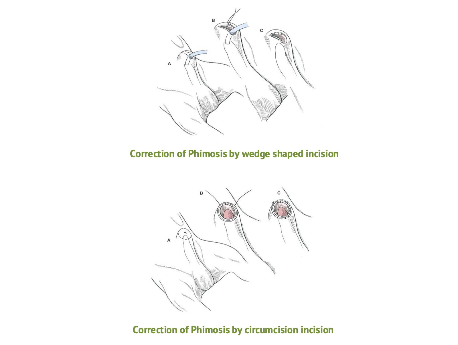 Surgical Procedure of Phimosis in Bulls