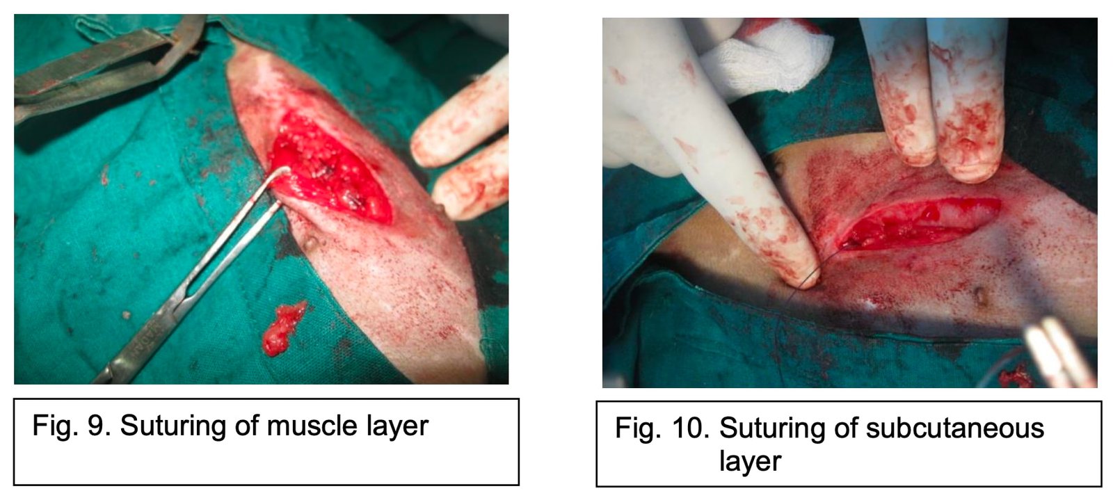 Suturing of muscle layer and Suturing of subcutaneous layer