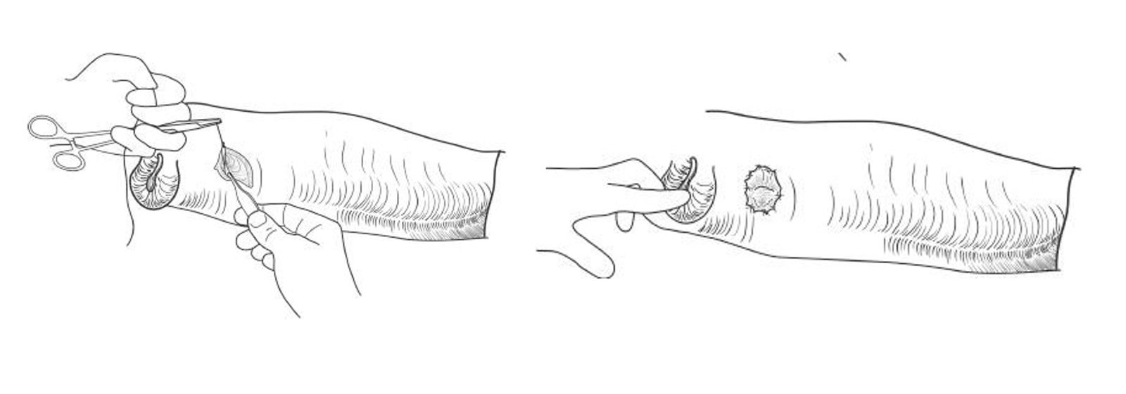 Suturing of preputial mucosa to the sheath skin