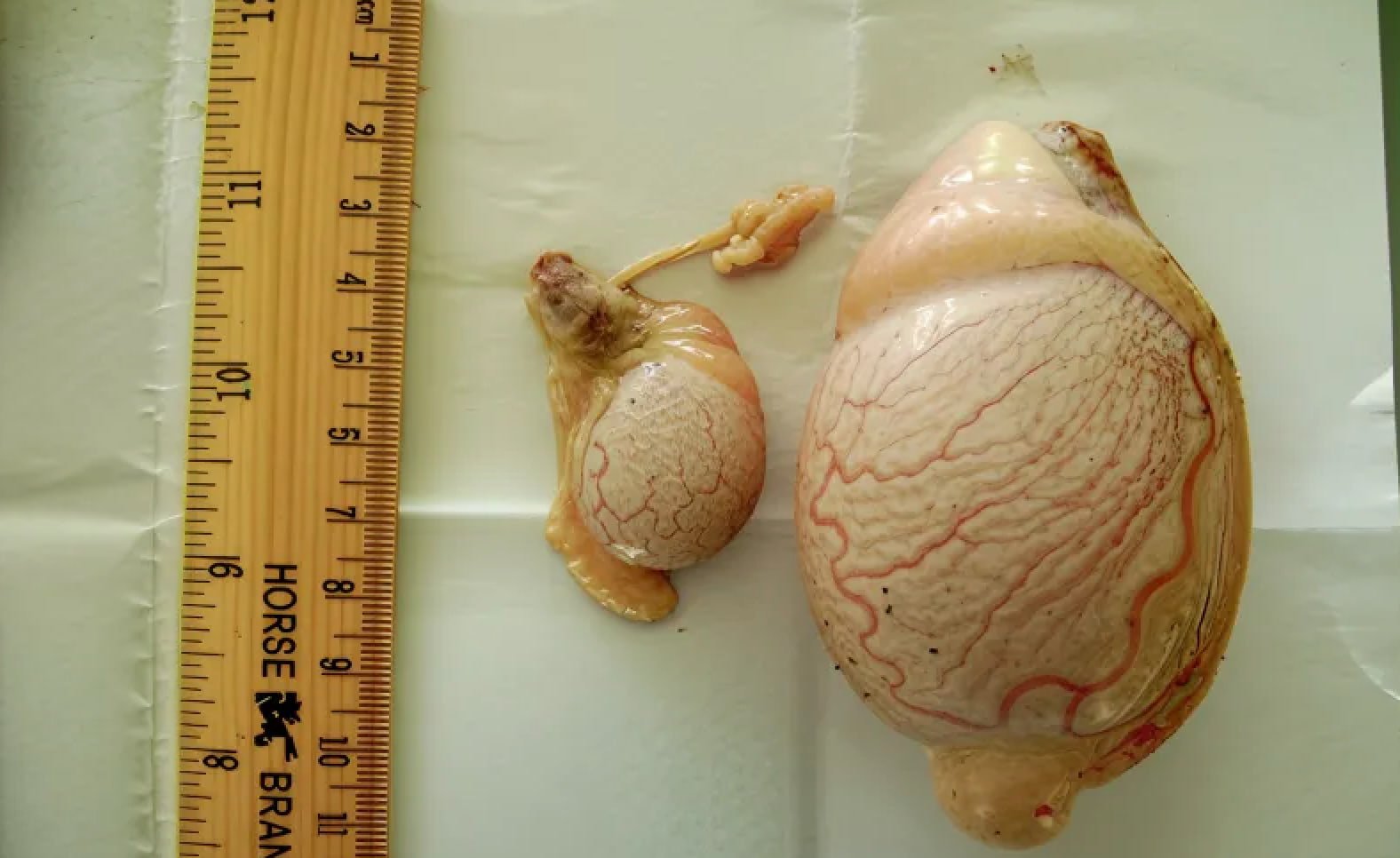 Testicular Hypoplasia