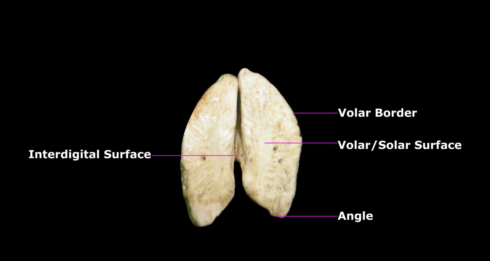 Third Phalanges - Volar View