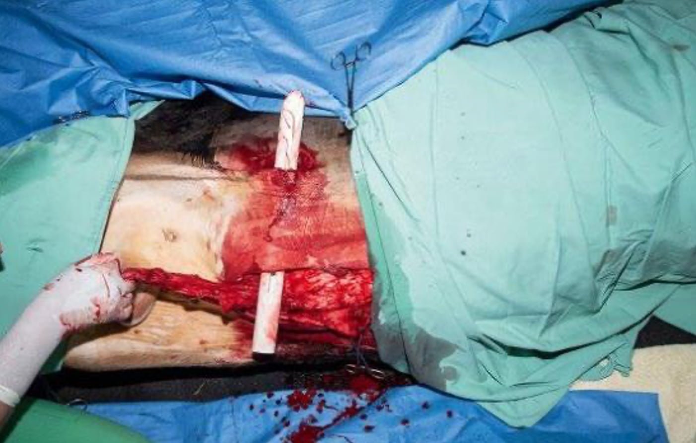 Use of a Cold Sterilized PVC Pipe to facilitate tunneling of Penile Translocation and Skin incision for the Translocation Site
